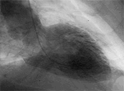 HerzkatheterLV-Angiographie